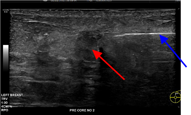 Ultrasound hypoechoic and hyperechoic